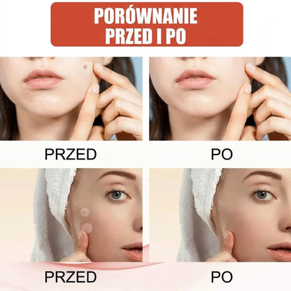 Plasterki hydrokoloidowe na niedoskonałości – 144 szt.